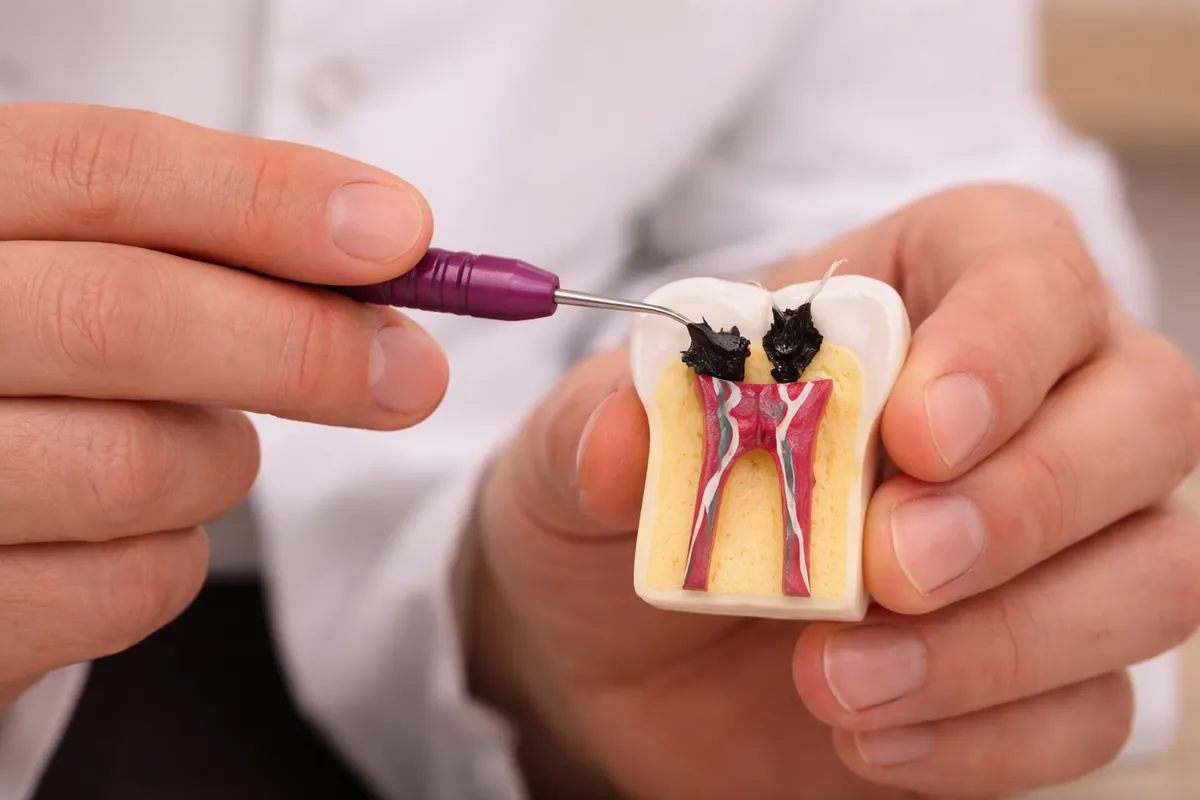Endodontia (Canal)