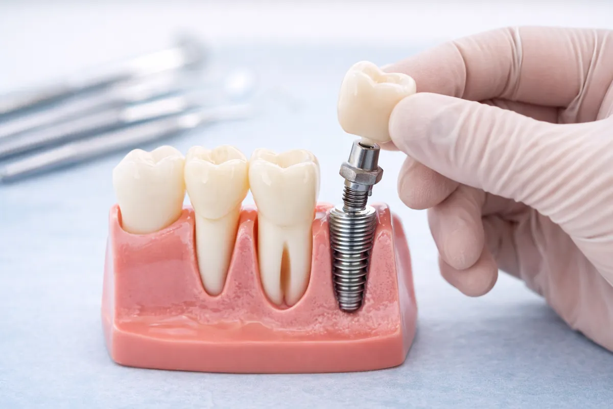 Implantes Dentários