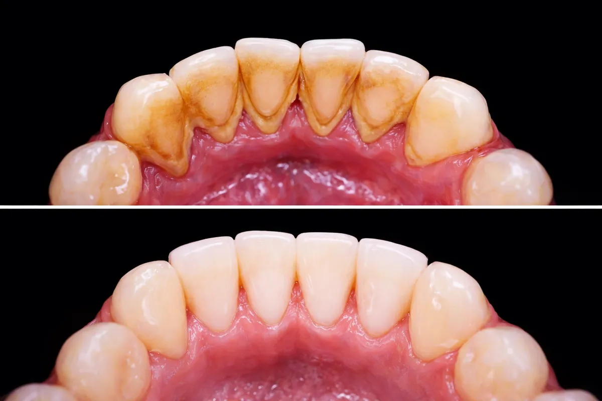 Limpeza Dental