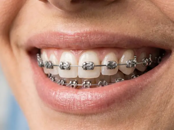 Close de sorriso com aparelho autoligado