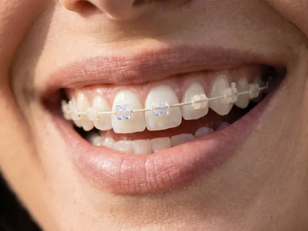 Close de sorriso com aparelho estético cerâmico