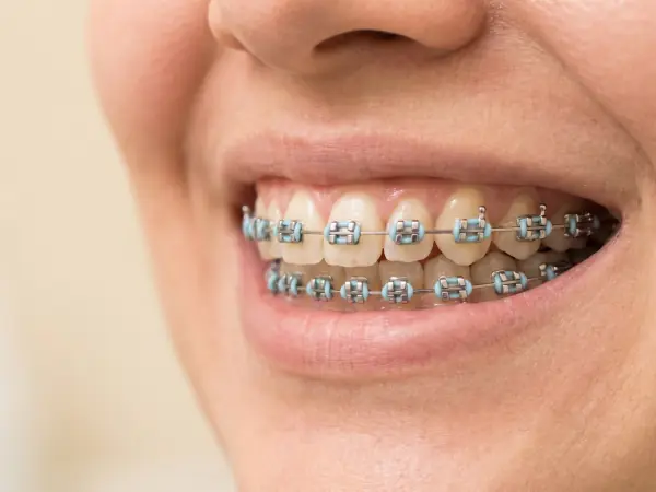 Close de sorriso com aparelho metálico tradicional